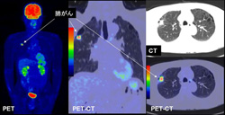 PETとPET-CTで確認できる早期の肺がん