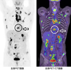 PETとPET-CTで確認できる早期の胃がん