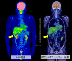 PETとPET-CTで確認できる早期の直腸がん