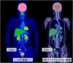 PETとPET-CTで確認できる早期の大腸がん