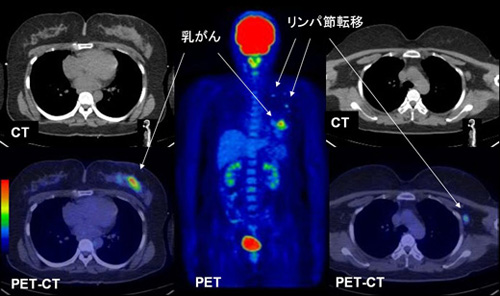 PET-CTで確認できる早期の乳がん