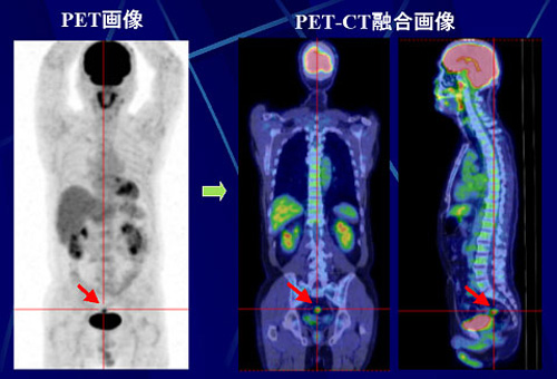 PET診断画像のイメージ