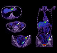 PET-CTによる子宮の診断画像イメージ