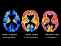 PET-CTによる脳の診断画像イメージ