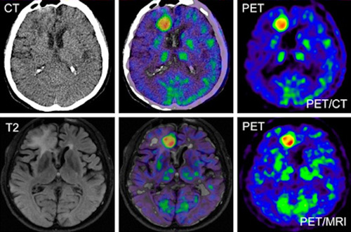 PET-CT・MRIによる脳の診断画像イメージ